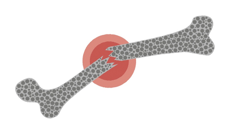 Osteoporóza ilustrace