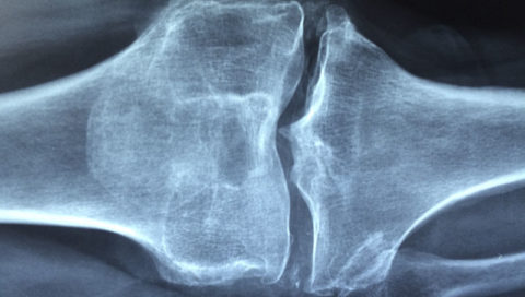 Kost koleno rentgen
